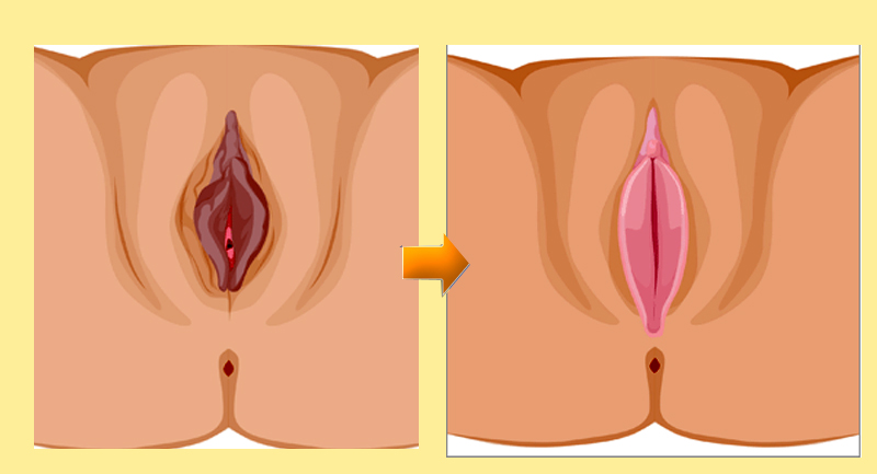 Labiaplasty procedure diagram